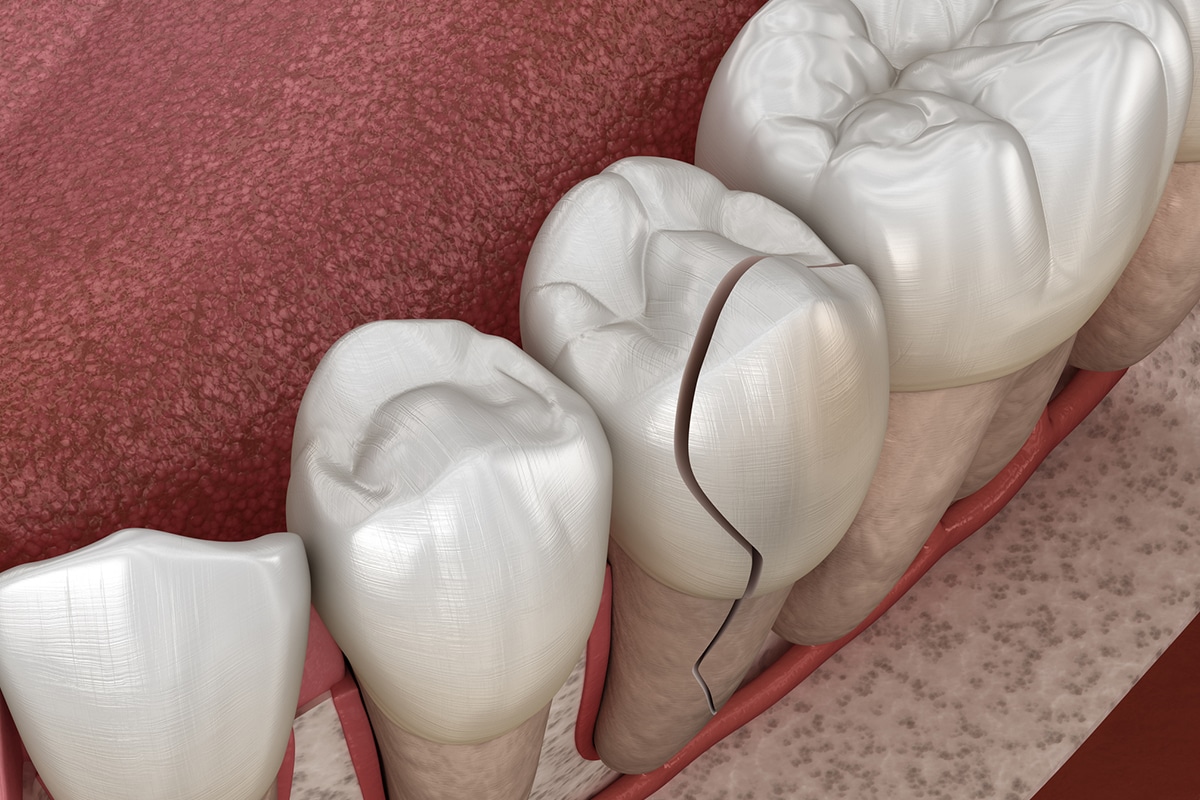 Cracked tooth or lost filling when to see a pediatric emergency dentist blog
